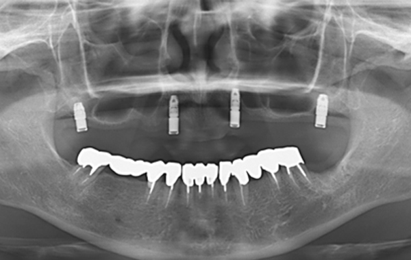 当院のインプラント症例実績